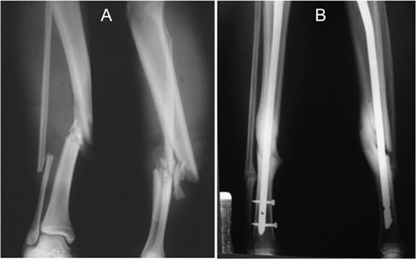 Radiografia de fratura na perna antes e depois da cirurgia