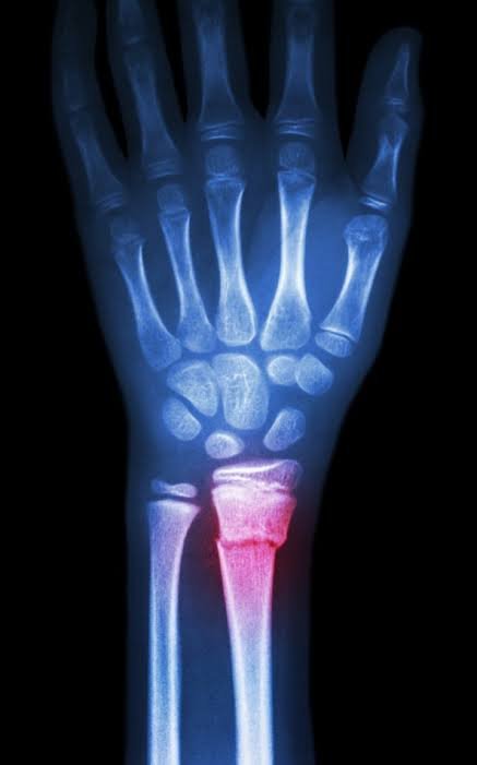 Radiografia de fratura no punho