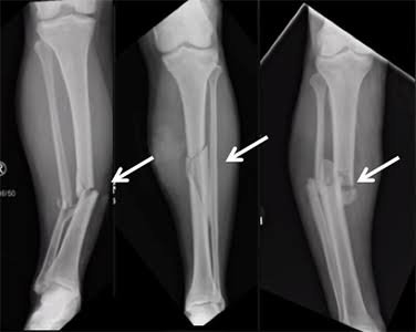 Radiografia de fratura na tíbia