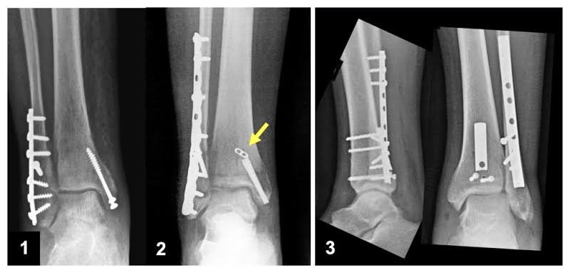 Radiografia de fratura no tornozelo com placa e parafusos